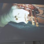 Innowacyjna operacja skoliozy w Szpitalu w Puszczykowie